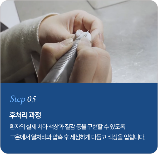 보철물 제작 과정 Step 5